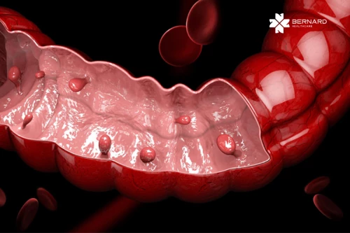 Polyp đại tràng và nguy cơ tiến triển thành ung thư: Đừng bỏ lỡ giai đoạn sớm